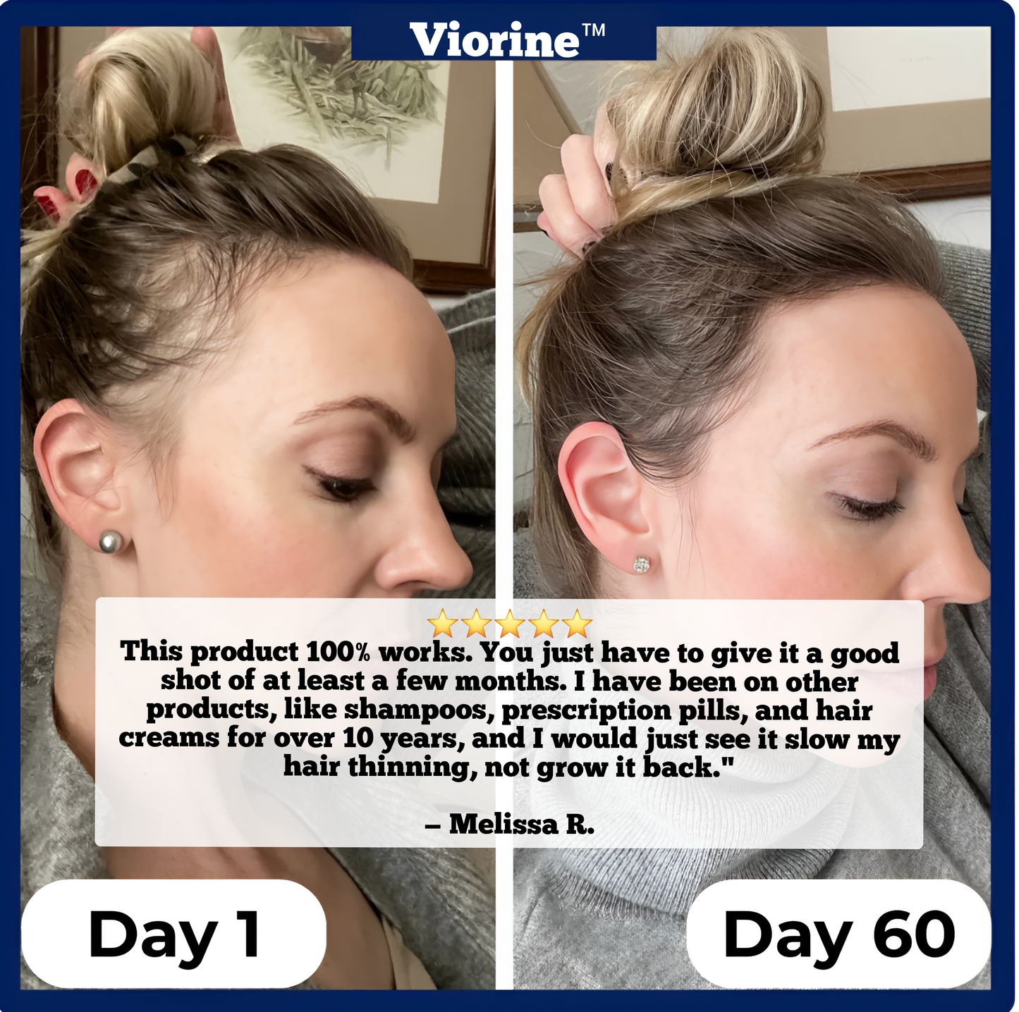 Viorine™ Hair Regrowth Roll-On Serum